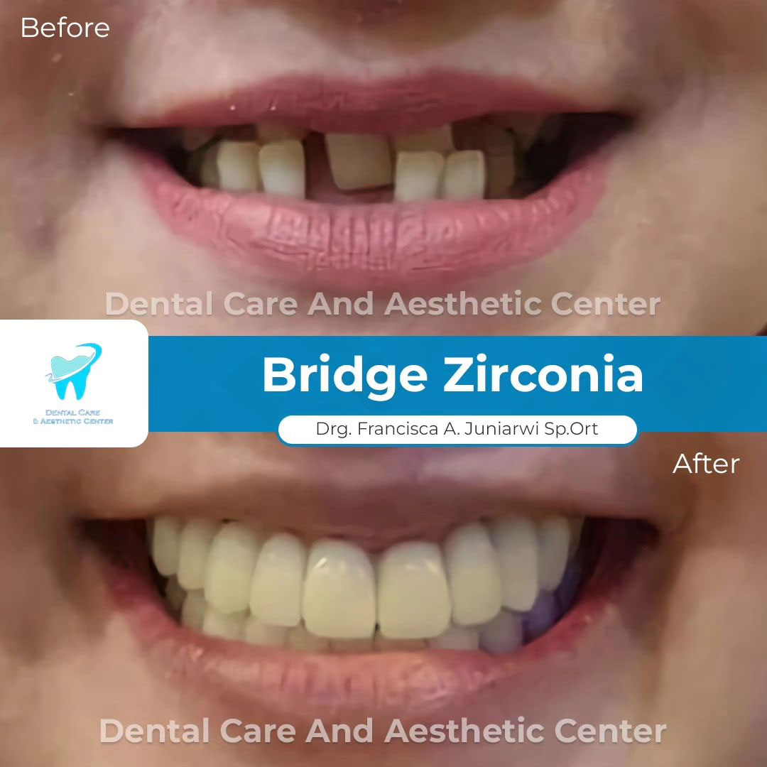 Bridge Zirconia