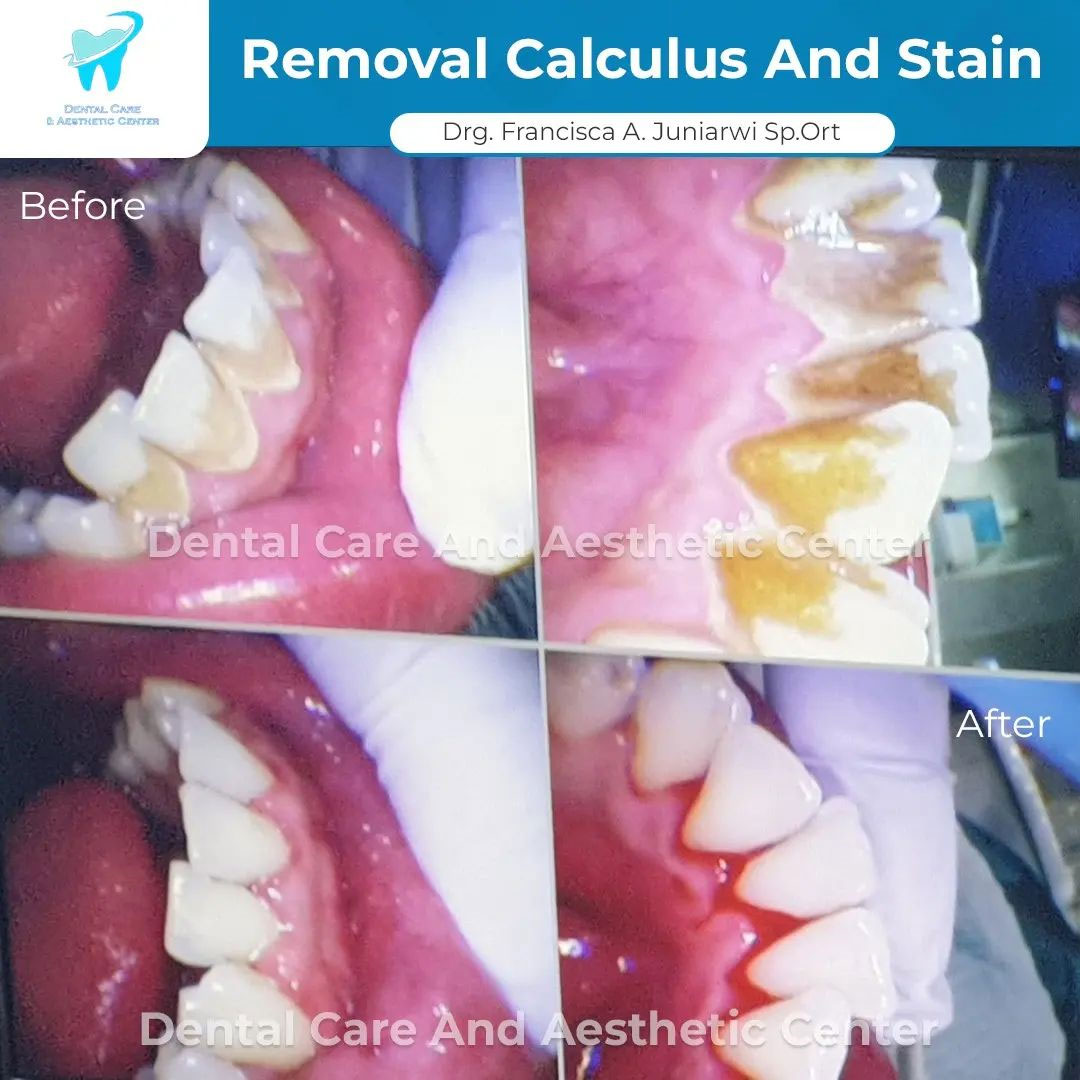 Removal Calculus and Stain