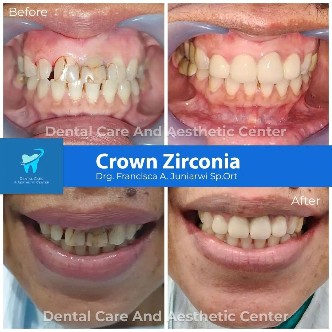Crown Zirconia