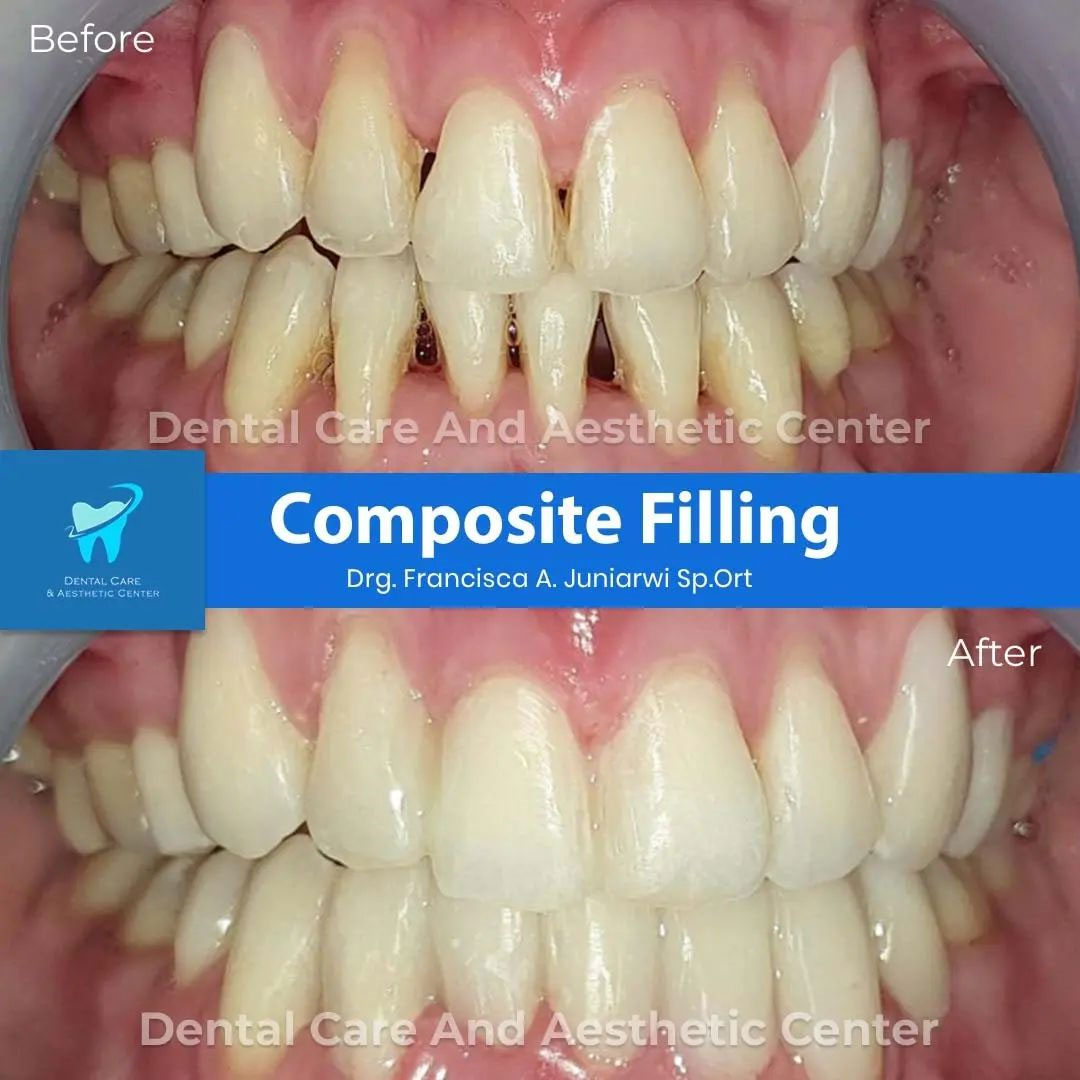 Composite Filling