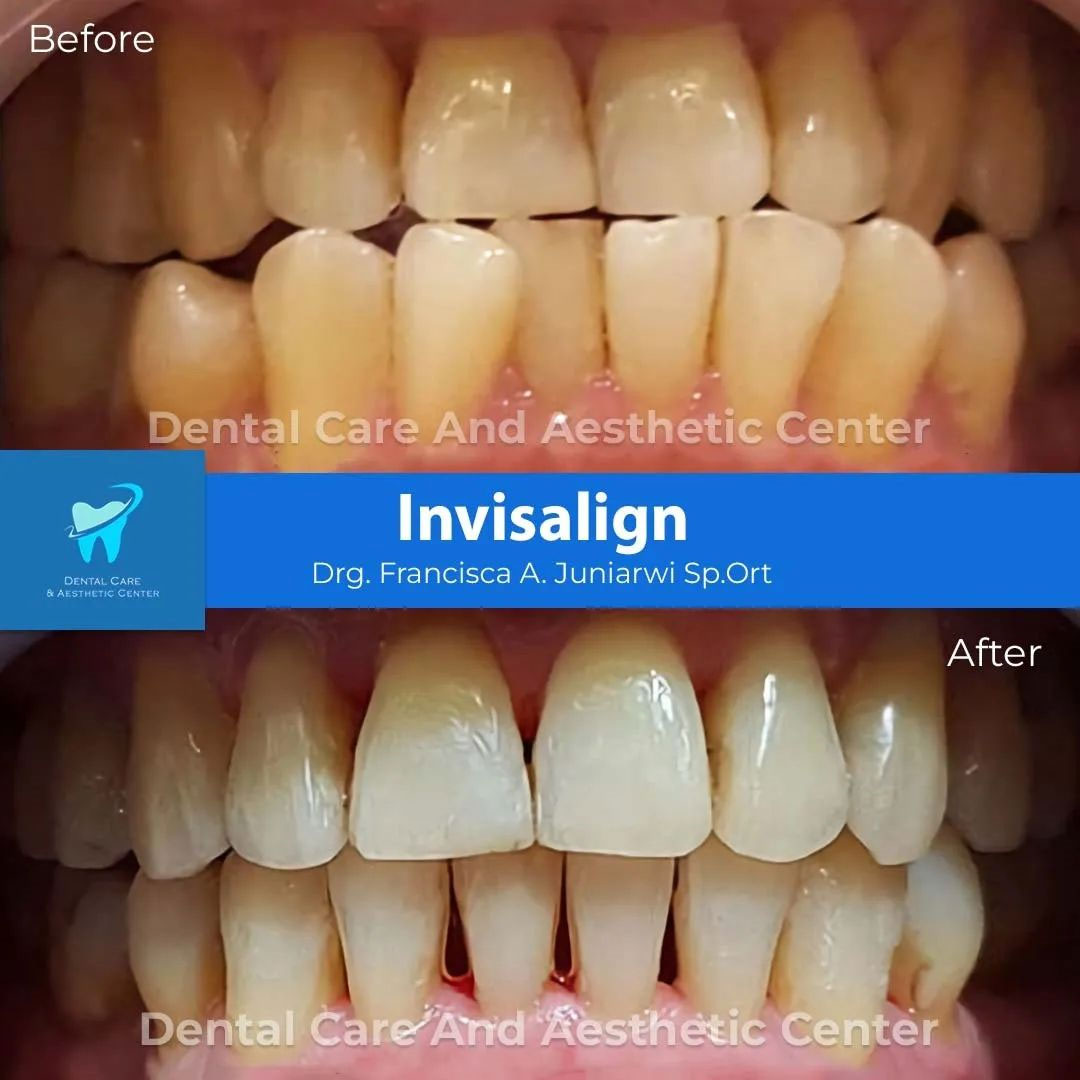 Invisalign 